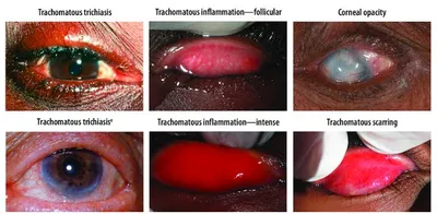 மக்களே    கண் பார்வையை பாதிக்கும் ட்ரக்கோமா நோய்     இருமல்  தும்மல் மூலம் பரவும்    