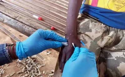 சின்னம்மை தடுப்பூசி போட்டவர்கள் mpox வைரஸில் இருந்து தப்பிக்கலாம்   நிபுணர்கள் தகவல் 